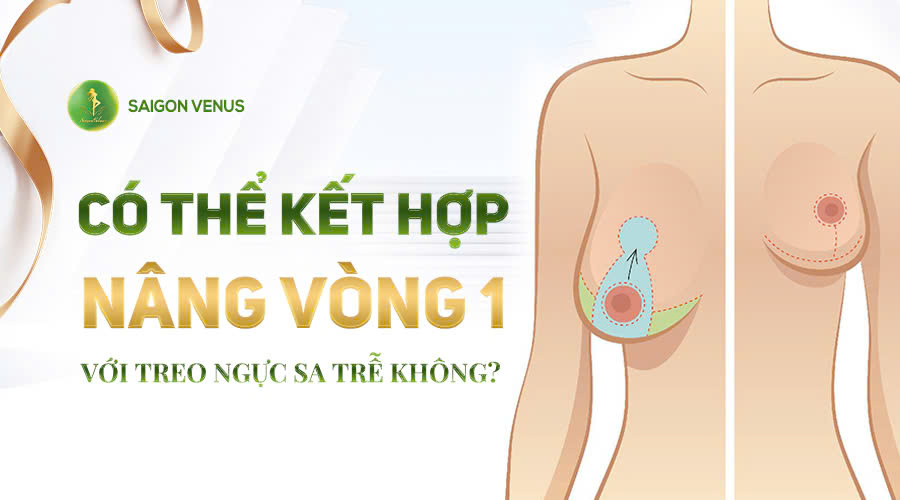 CÓ THỂ KẾT HỢP NÂNG V1 VỚI TREO SA TRỄ ĐƯỢC KHÔNG?