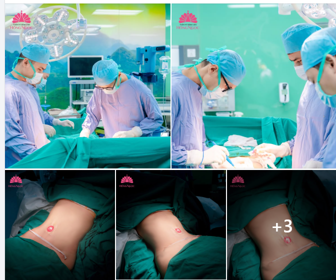 90 PHÚT CHẠM ĐẾN “CHIẾC EO MƠ ƯỚC” VỚI COMBO HÚT MỠ & TẠO HÌNH THÀNH BỤNG 