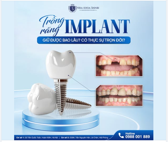 Implant giữ được bao lâu? Có thực sự trọn đời?