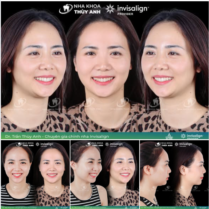THAY ĐỔI MỘT NỤ CƯỜI, THAY ĐỔI CẢ THẦN THÁI TỰ TIN