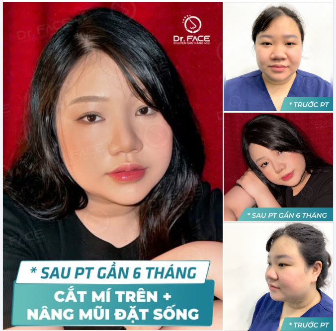 NÂNG MŨI – CẮT MÍ 6 tháng: ĐIỀU DƯỠNG DR.FACE khiến ai cũng TRẦM TRỒ!