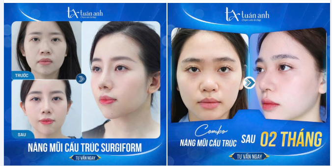 NÂNG MŨI CẤU TRÚC SURGIFORM - CHUẨN FORM TỰ NHIÊN, BỀN ĐẸP THEO THỜI GIAN