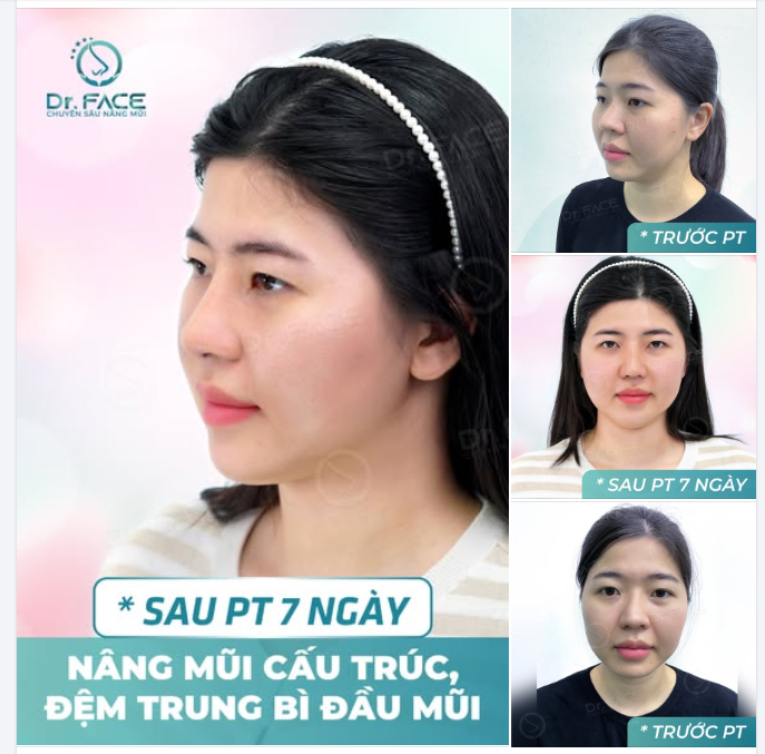 CÙNG LÀ NÂNG MŨI NHƯNG LẦN NÀY “HIỀN” HƠN