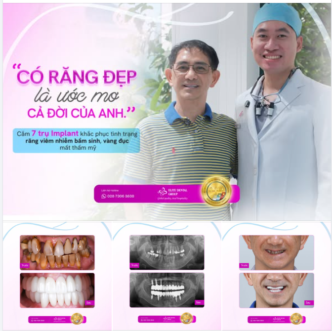 TRỒNG RĂNG IMPLANT - THÀNH CÔNG HIỆN THỰC HOÁ ƯỚC MƠ CẢ ĐỜI VỀ MỘT HÀM RĂNG ĐẸP