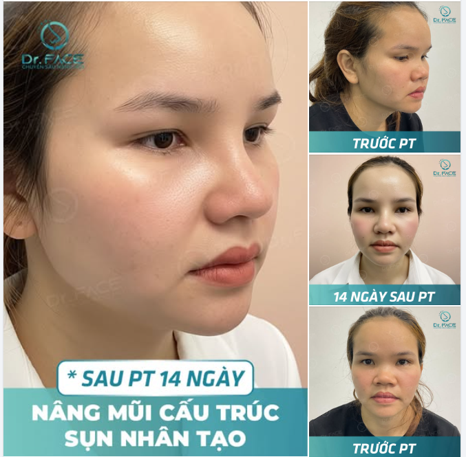 Nâng mũi chuẩn dáng thiên thần,  Tự tin tỏa sáng muôn phần yêu thương.