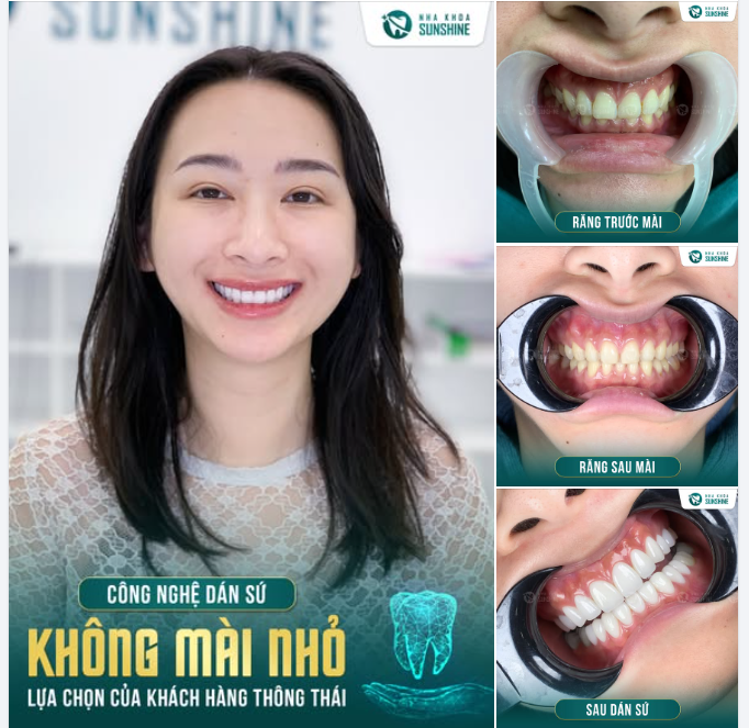 Không ít khách hàng mong muốn có một nụ cười đẹp hơn, đều màu hơn, nhưng lại ngần ngại vì sợ răng bị MÀI NHỎ, YẾU ĐI HOẶC Ê BUỐT.