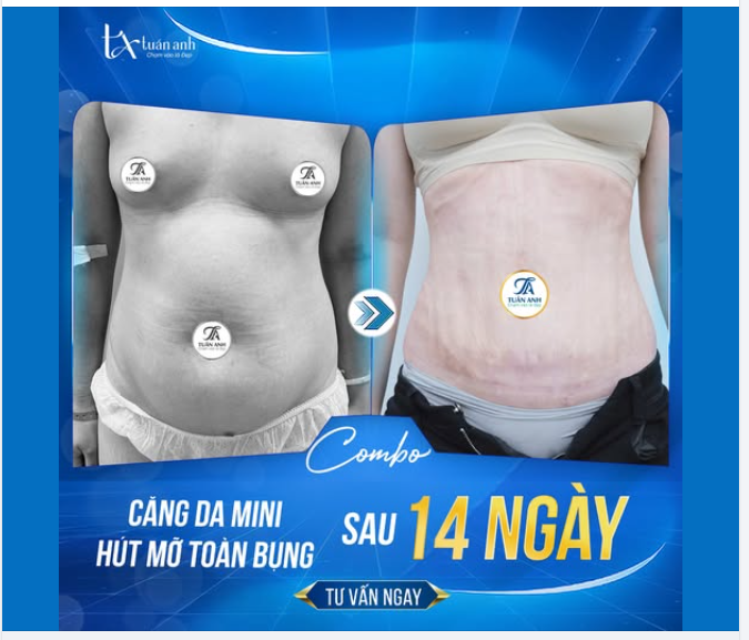 XOÁ BỎ MỠ THỪA VÀ DA CHÙNG CHỈ SAU 14 NGÀY