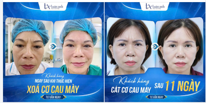 CẮT CƠ CAU MÀY - GIẢI PHÁP “XÓA NHĂN” CHO VẦNG TRÁN!