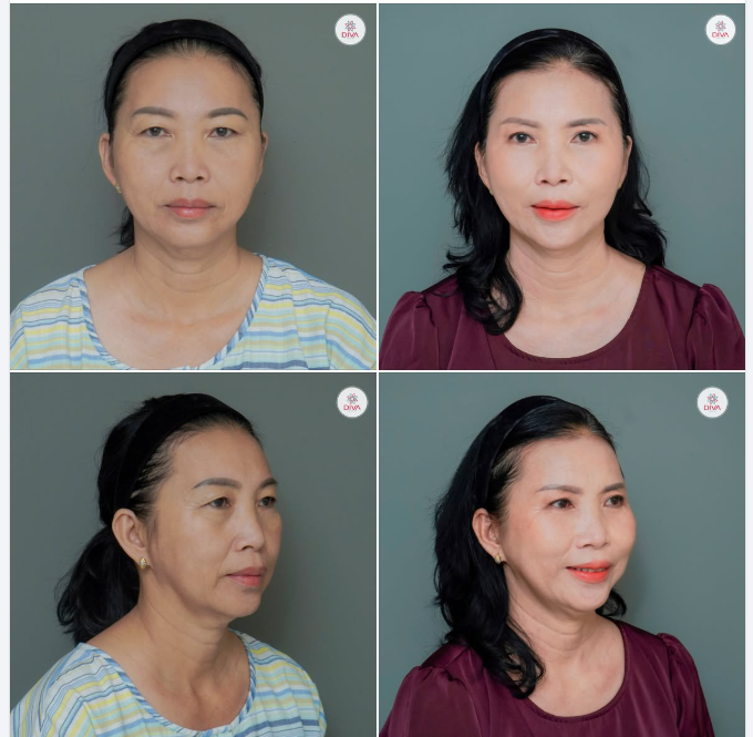 THAY ĐỔI CẢ THẦN THÁI KHUÔN MẶT NHỜ CẢI THIỆN NHỮNG KHUYẾT ĐIỂM "TUỔI TÁC" Ở ĐÔI MẮT!