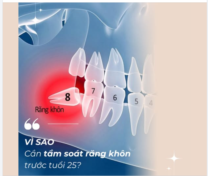 RĂNG KHÔN KHÔNG TẦM SOÁT SỚM LIỆU SẼ GÂY NGUY HIỂM?