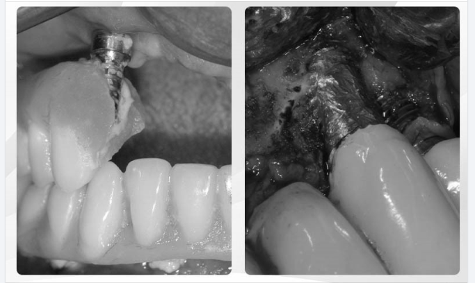 Trồng răng Implant bất chấp và hậu quả không thể kể hết..