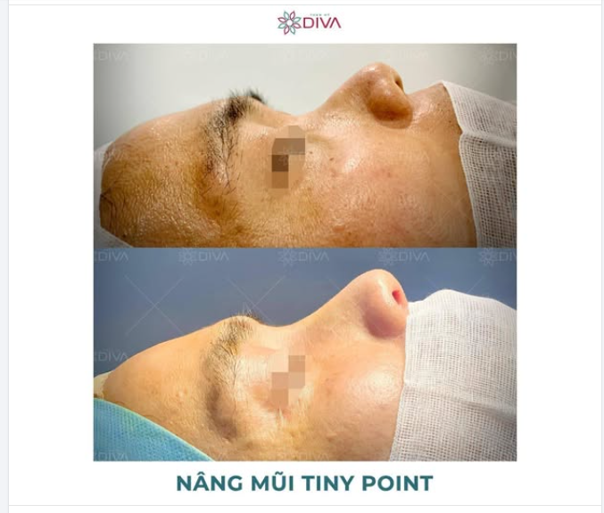 NÂNG MŨI TINY POINT - PHƯƠNG PHÁP LÀM ĐẸP VÙNG MŨI PHÙ HỢP VỚI NAM GIỚI