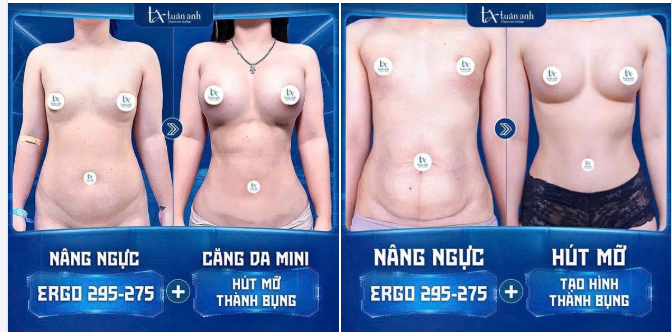 CHẤM DỨT NỖI SỢ HÃI VÒNG 2 CHẢY XỆ VÀ VÒNG 1 KHIÊM TỐN SAU SINH