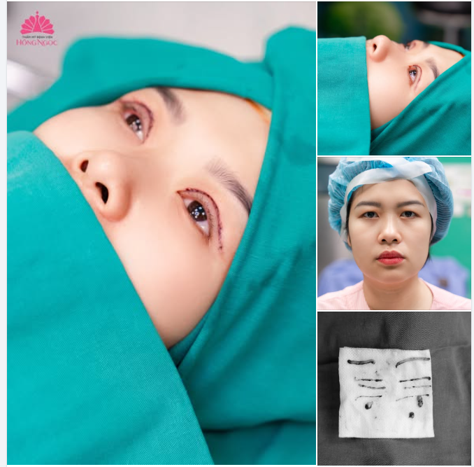 Thay đổi nhỏ, khác biệt lớn - Cùng xem hành trình “lột xác” của khách hàng sau cắt mí Hàn Quốc tại Thẩm mỹ Bệnh viện Hồng Ngọc!