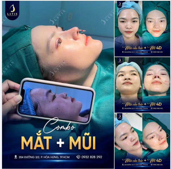 CHỈNH MÍ - NÂNG MŨI XONG, NỤ CƯỜI TỰ LÊN TIẾNG