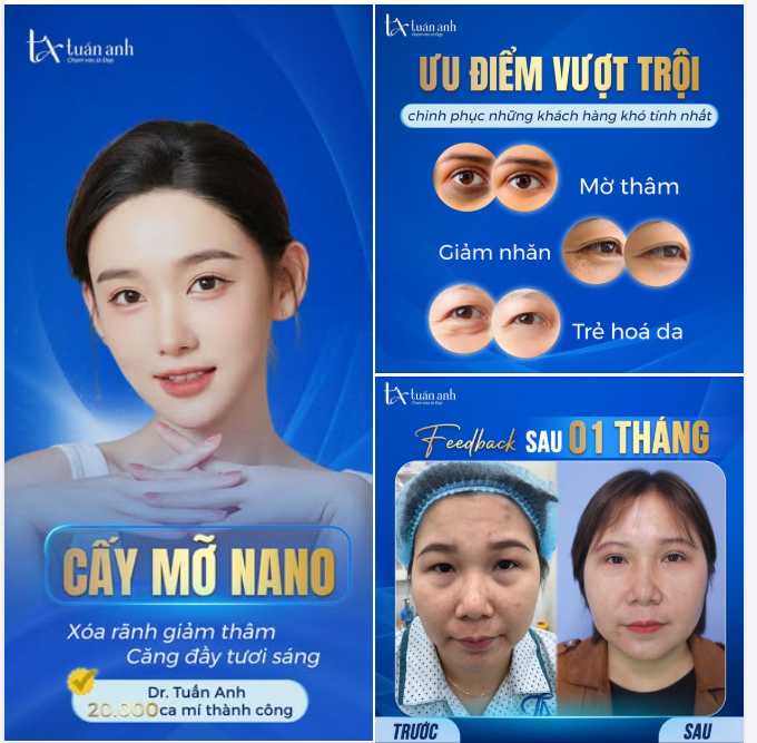 CẤY MỠ NANO: Bí mật "ăn gian 10 tuổi" cho đôi mắt
