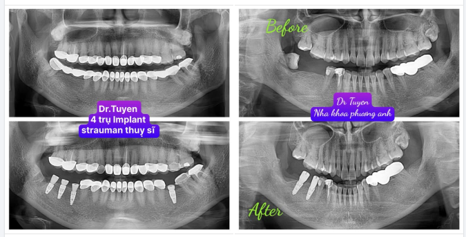 Implant có bền suốt đời không, có phải thay sau vài năm không?