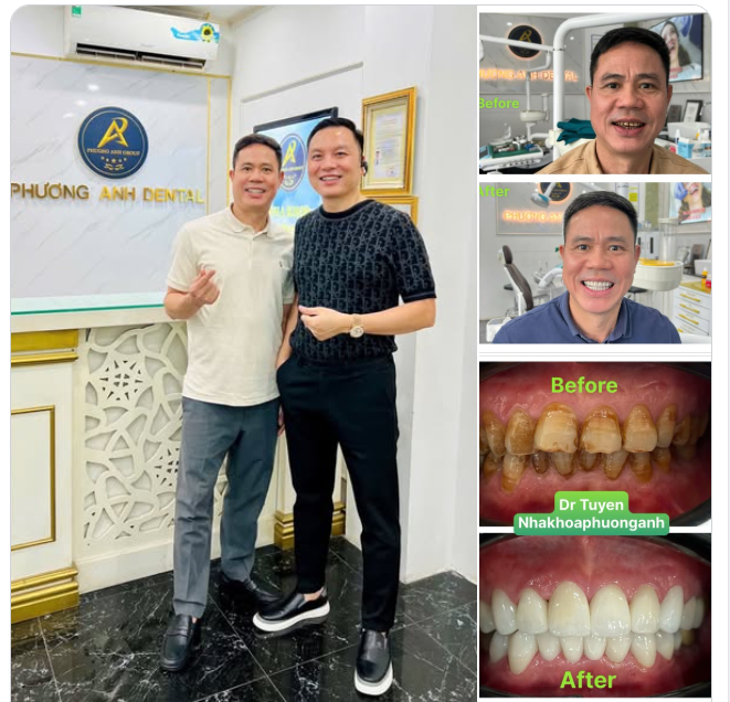 Anh ấy to cao! Anh ấy làm sếp … nhưng nụ cười của anh ấy chỉ được 05 điểm Còn sau khi làm răng xong! Anh ấy 10 điểm không có nhưng