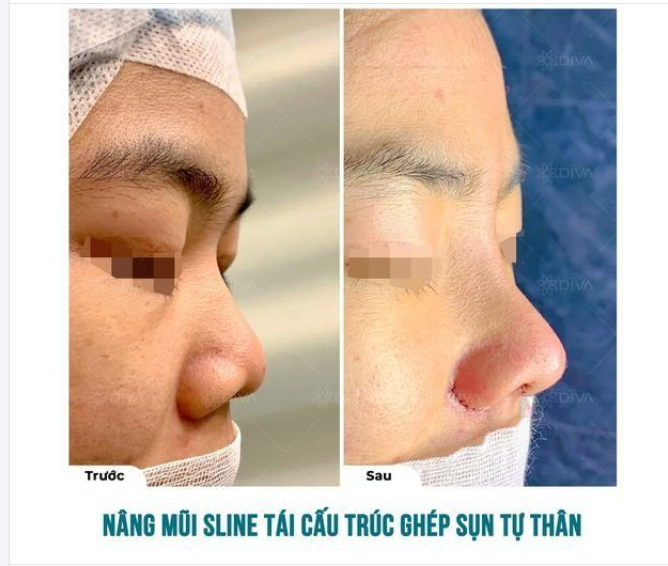 NÂNG MŨI TÁI CẤU TRÚC SLINE GIÚP CẢI THIỆN TÌNH TRẠNG SỐNG MŨI THẤP, CÁNH MŨI TO