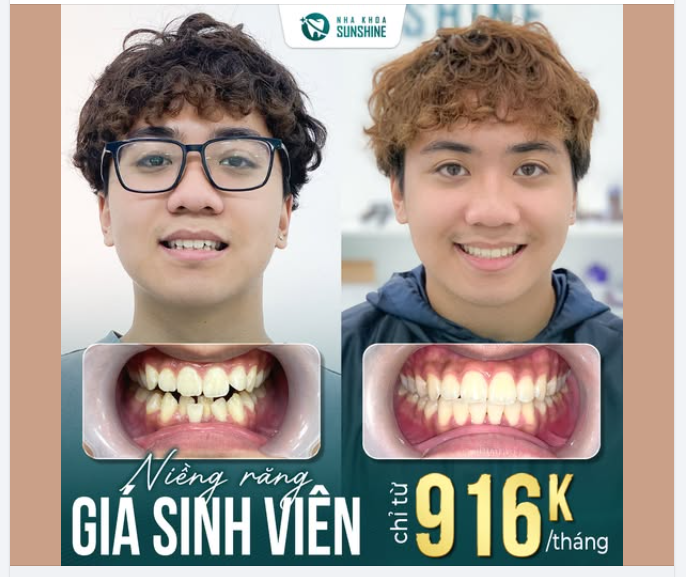 NIỀNG RĂNG GIÁ SINH VIÊN – CHỈ 916K/THÁNG