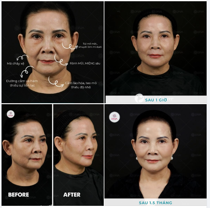 GIẢI PHÁP NÀO GIÚP CẢI THIỆN SỰ CHẢY XỆ, CÁC DẤU HIỆU LÃO HÓA TRÊN KHUÔN MẶT MÀ CÓ THỂ THẤY NGAY KẾT QUẢ?