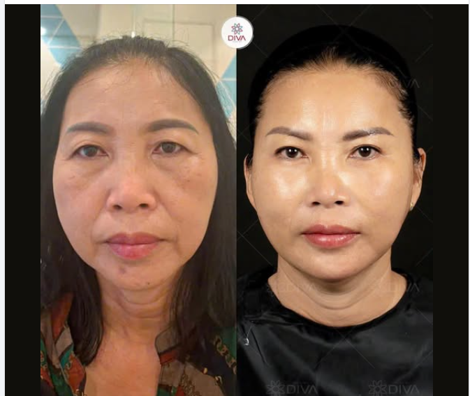 VÌ SAO LẠI CHỌN PHƯƠNG PHÁP FILLER MD CODES?
