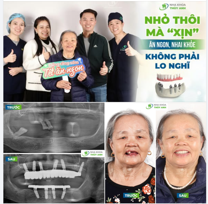TRỒNG RĂNG CHO MẸ ĐÓN TẾT TRỌN NIỀM VUI