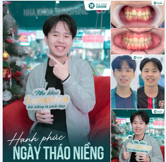 Hạnh phúc nhất mùa Noel này chính là… tháo niềng với nụ cười đẹp như ý!