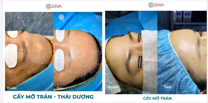 CẤY MỠ TRÁN - PHƯƠNG PHÁP ĐIỀU CHỈNH NHẸ NHÀNG NHƯNG HIỆU QUẢ LỚN CHO KHUÔN MẶT