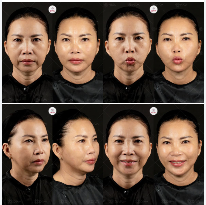 GIẢM SỰ CO RÚT CƠ, ĐIỀU TRỊ C.HẢY XỆ KHUÔN MẶT VỚI 14CC FILLER MD CODES!