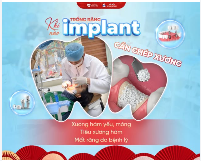 GHÉP XƯƠNG - GIẢI PHÁP CHO NHỮNG NỀN HÀM YẾU TRONG TRỒNG RĂNG IMPLANT
