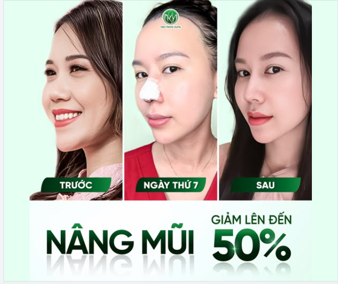 1 tháng nữa đến Tết, nâng mũi kịp không?