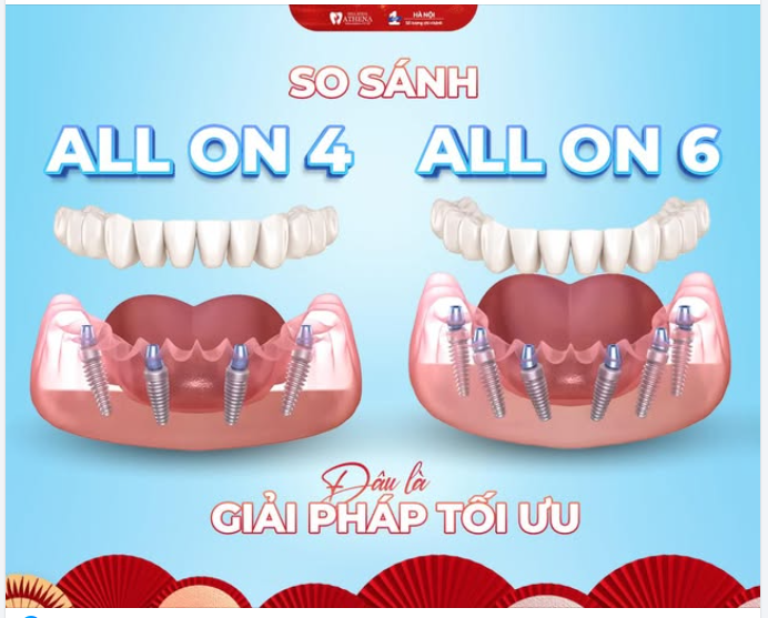 MẤT RĂNG TOÀN HÀM: CHỌN IMPLANT ALL-ON-4 HAY ALL-ON-6 ĐỂ TẬN HƯỞNG CUỘC SỐNG?