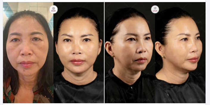 VỚI 14CC FILLER MD CODES, KHUÔN MẶT TRỞ NÊN TRẺ TRUNG TƯƠI TẮN HƠN NHỜ SỰ CHẶN CO CƠ QUÁ MỨC!