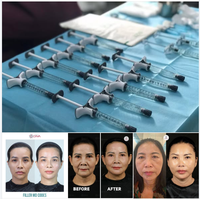 KHÓE MŨI MIỆNG SÂU (RÃNH CƯỜI) - CẢI THIỆN NHƯ THẾ NÀO?
