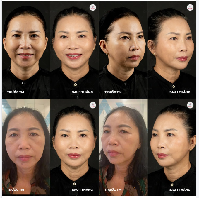 KẾT QUẢ SAU 1 THÁNG TIÊM 14CC FILLER MD CODES NHƯ THẾ NÀO?