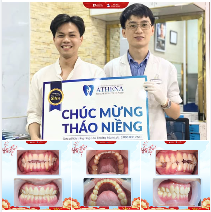 HẠ HOÀI NAM (1996): “QUYẾT ĐỊNH ĐÚNG ĐẮN NHẤT TUỔI 30 LÀ CHỌN ĐÚNG NHA KHOA NIỀNG RĂNG!”