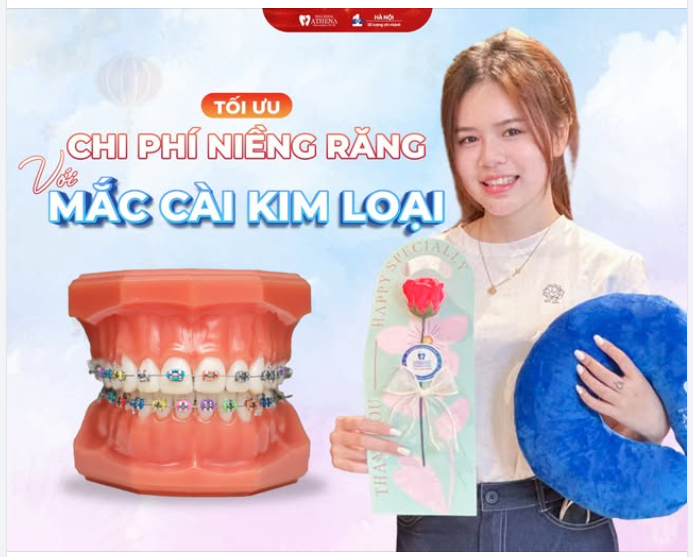 TỐI ƯU CHI PHÍ NIỀNG RĂNG VỚI MẮC CÀI KIM LOẠI