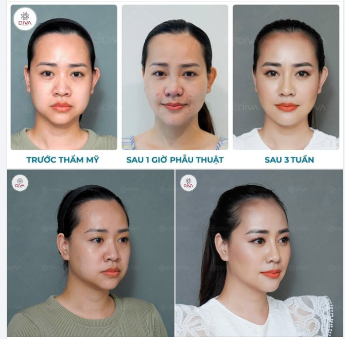 SỞ HỮU NHAN SẮC “NHÌN LÀ MÊ” SAU THẨM MỸ
