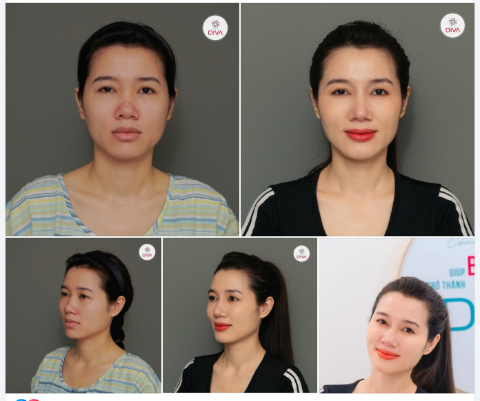 THAY ĐỔI NHẸ NHÀNG - MANG LẠI THẦN THÁI TƯƠI TẮN NHỜ NÂNG MŨI TINY POINT VÀ CẤY MỠ CẰM