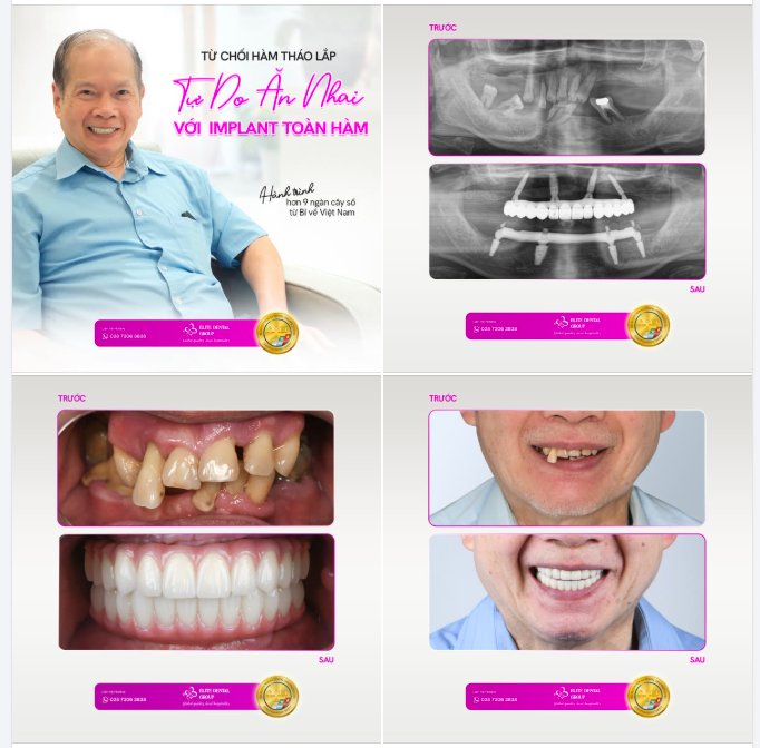 THƯỜNG XUYÊN "NUỐT TRỌNG" VÌ CHỈ CÒN 12 RĂNG LUNG LAY - CHÚ TRUNG TRỰC KHÔNG CHẤP NHẬN ĐỀ XUẤT LÀM HÀM THÁO LẮP CỦA BÁC SĨ TẠI BỈ