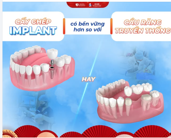 MẤT RĂNG!!!! ĐÂU LÀ PHƯƠNG PHÁP BỀN VỮNG HƠN