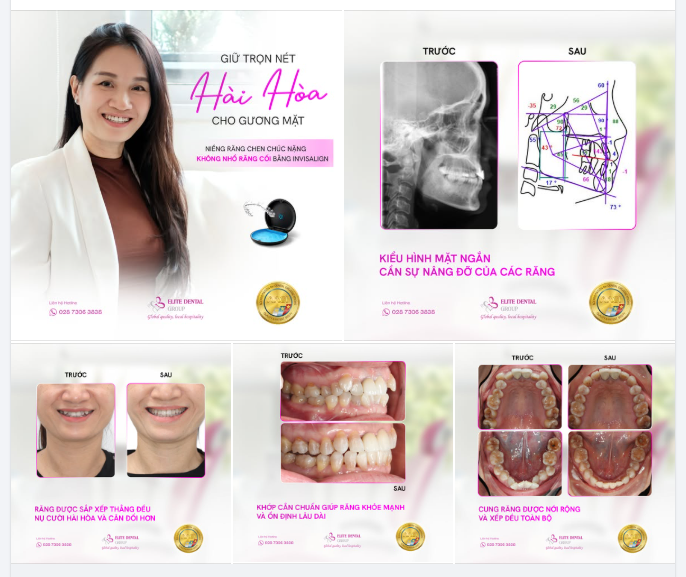 NIỀNG RĂNG INVISALIGN CHO RĂNG CHEN CHÚC - KHÔNG NHỔ RĂNG CỐI