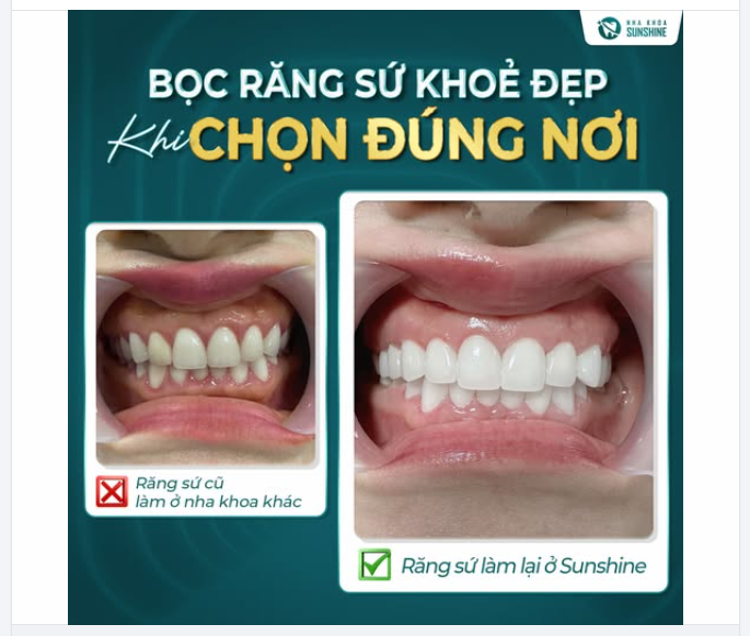 HỐI HẬN VÌ KHÔNG BIẾT ĐẾN SUNSHINE SỚM HƠN ​​​​​​​ HẬU QUẢ KHI LỰA CHỌN NHA KHOA KHÔNG UY TÍN.