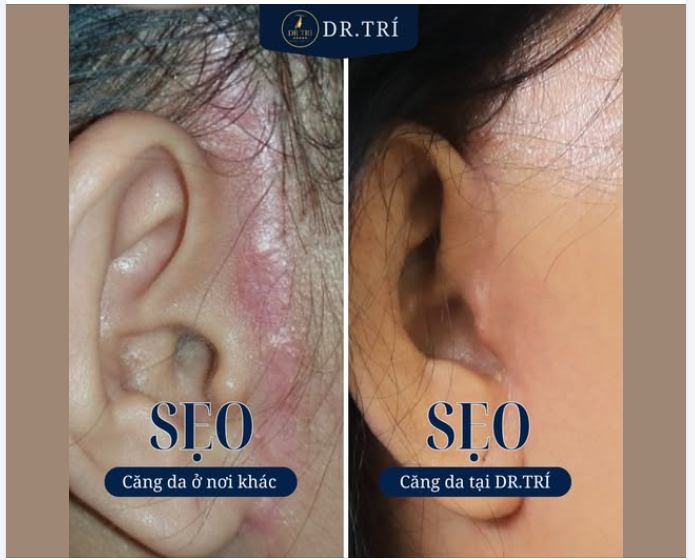 TẾT NÀY TỰ TIN KHOE SẮC – ĐỪNG ĐỂ "SẸO XẤU" LÀM RÀO CẢN!