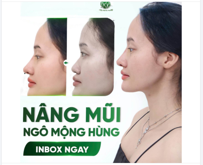 Kết ngọt cho chị KH nâng mũi trước Tết   Nâng mũi giảm đến 50%