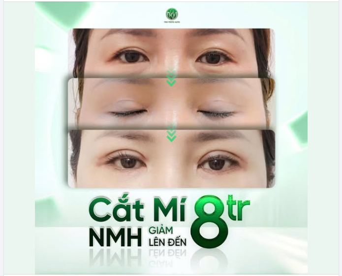Sau khi cắt mí tại BV PTTM Ngô Mộng Hùng sẽ như thế nào?