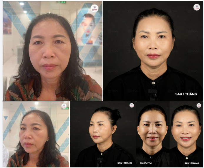 CẢI THIỆN SỰ ĐỨT GÃY TẦNG MẶT GIỮA, RÃNH CƯỜI VÀ C.HẢY XỆ KHUÔN MẶT NHỜ FILLER MD CODES!