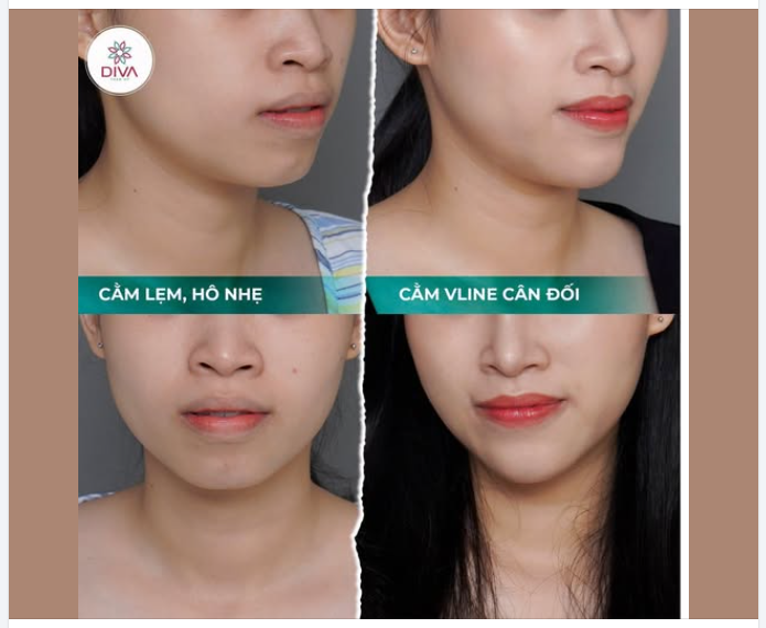 CẤY MỠ CẰM – “CHỮA” CẰM LẸM, TĂNG ĐỘ NHÔ TỰ NHIÊN, KHUÔN MẶT TRỞ NÊN HÀI HÒA HƠN