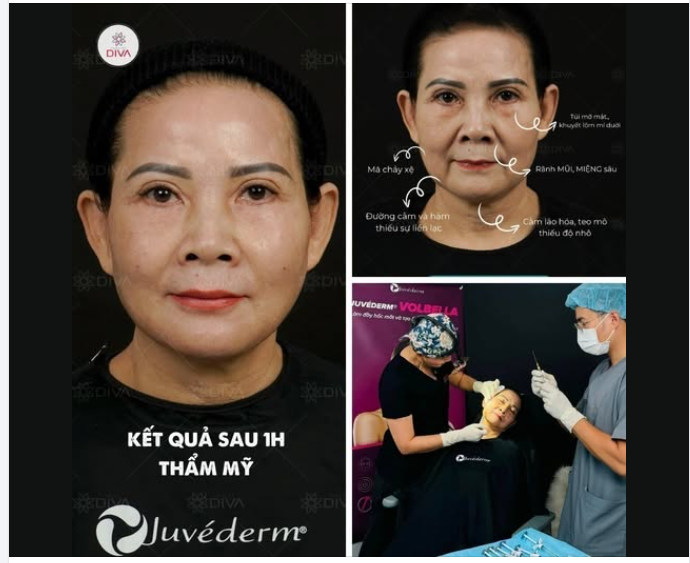 FILLER MD CODES - ĐIỀU TRỊ CHẢY XỆ, LÃO HÓA KHUÔN MẶT NHANH CHÓNG, KẾT QUẢ THẤY RÕ NGAY SAU KHI THỰC HIỆN